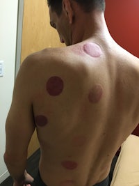 a man with red dots on his back